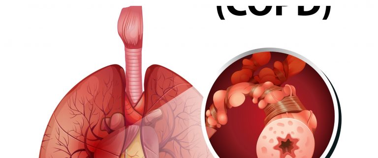 Understanding COPUnderstanding COPD – Causes, Symptoms, and Prevention TipsD – Causes, Symptoms, and Prevention Tips