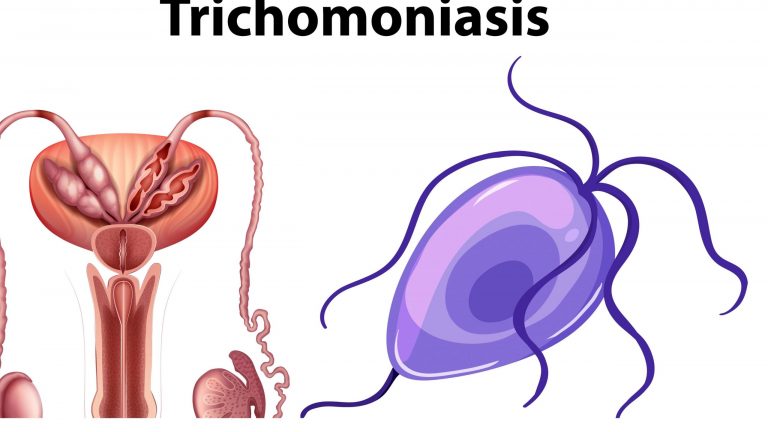 All about Trichomoniasis: Causes, Symptoms, Diagnosis and Treatment