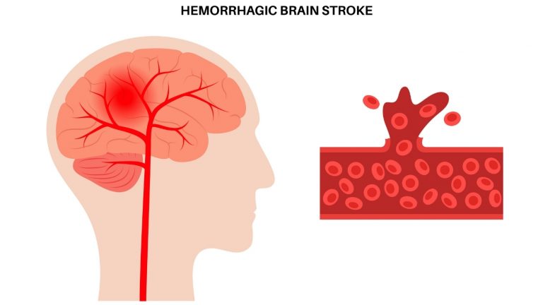 Haemorrhage Explained: Types, Causes, and Life-Threatening Risks